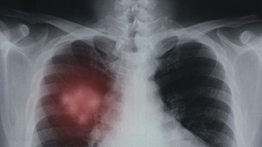 Artificial intelligence "finds" lung cancer
